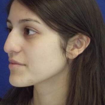 Dr Suzman Rhinoplasty Surgeon